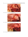 Implant Dentistry The Most Promising Discipline of Dentistry