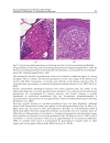 Sarcoidosis Diagnosis and Management