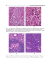 Sarcoidosis Diagnosis and Management