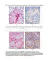 Sarcoidosis Diagnosis and Management