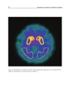 Diagnosis and Treatment of Parkinsonâ s Disease