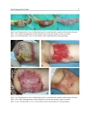 Skin Grafts Indications Applications and Current Research