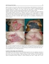 Skin Grafts Indications Applications and Current Research