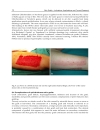 Skin Grafts Indications Applications and Current Research