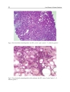 Liver Biopsy in Modern Medicine