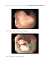 Endoscopic Procedures in Colon and Rectum