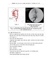 Đặc điểm hình ảnh và vai trò chụp cắt lớp vi tính tưới máu não trong chẩn đoán nhồi máu não hệ cảnh trong trên cắt lớp vi tính 64 dã