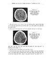 Đặc điểm hình ảnh và vai trò chụp cắt lớp vi tính tưới máu não trong chẩn đoán nhồi máu não hệ cảnh trong trên cắt lớp vi tính 64 dã