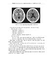 Đặc điểm hình ảnh và vai trò chụp cắt lớp vi tính tưới máu não trong chẩn đoán nhồi máu não hệ cảnh trong trên cắt lớp vi tính 64 dã