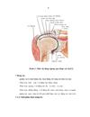 Đánh giá kết quả điều trị phẫu thuật sẹo vùng nách do di chứng bỏng