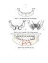 Nhận xột đặc điểm lõm sàng X quang và kết quả điều trị góy XHD vùng cằm do chấn thương tại Bệnh viện Răng Hàm Mặt trung ương 2010 201