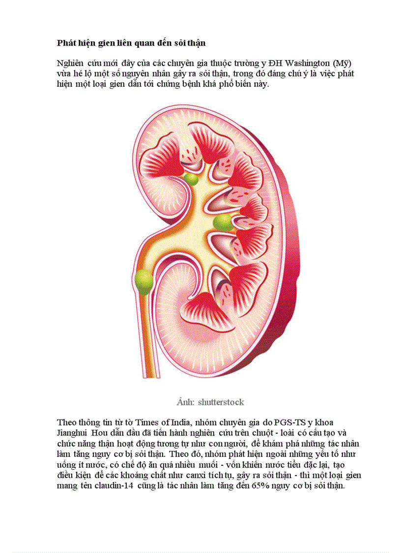 Phát hiện gien liên quan đến sỏi thận