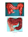 Bệnh ruột non và ruột già Disease of the small and large intestine