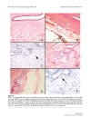 Báo cáo khoa học Giant breast tumors Surgical management of phyllodes tumors potential for reconstructive surgery and a review of literature