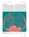 Báo cáo khoa học Giant retroperitoneal liposarcoma