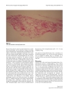 Báo cáo khoa học Giant retroperitoneal liposarcoma