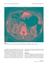 Báo cáo khoa học Giant retroperitoneal liposarcoma