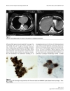 Báo cáo khoa học Delayed malignant melanoma recurrence simulating primary ovarian cancer Case report