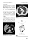 Lung adenocarcinoma presenting as obstructive jaundice a case report and review of literature