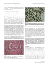 Lung adenocarcinoma presenting as obstructive jaundice a case report and review of literature