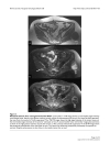 Bilateral gluteal metastases from a misdiagnosed intrapelvic gastrointestinal stromal tumor