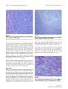 Bilateral gluteal metastases from a misdiagnosed intrapelvic gastrointestinal stromal tumor