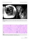 Post radiation sciatic neuropathy a case report and review of the literature