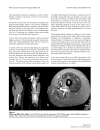 Post radiation sciatic neuropathy a case report and review of the literature