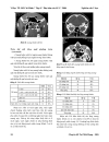 Hình ảnh xoang bướm trên CT Scan