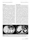 Hepatobiliary cystadenoma exhibiting morphologic changes from simple hepatic cyst shown by 11 year follow up imagings