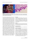 Hepatobiliary cystadenoma exhibiting morphologic changes from simple hepatic cyst shown by 11 year follow up imagings