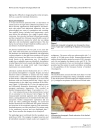 Ileoileal intussusception induced by a gastrointestinal stromal tumo