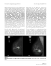 Squamous cell carcinoma of the breast a case report