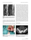 Báo cáo khoa học Transsacral colon fistula late complication after resection irradiation and free flap transfer of sacral chondrosarcoma