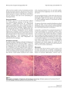 The synchronous occurrence of squamous cell carcinoma and gastrointestinal stromal tumor GIST at esophageal site