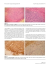 The synchronous occurrence of squamous cell carcinoma and gastrointestinal stromal tumor GIST at esophageal site