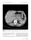 Experience with adjuvant chemotherapy for pseudomyxoma peritonei secondary to mucinous adenocarcinoma of the appendix with oxaliplatin fluorouracil leucovorin FOLFOX4