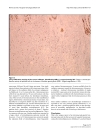 Intramucosal leiomyosarcoma of the stomach following hereditary retinoblastoma in childhood a case report and review of the literature