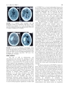 Báo cáo y học Plasmatic B Type Natriuretic Peptide and C Reactive Protein in Hyperacute Stroke as Markers of Ct Evidence of Brain Edema