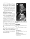 Báo cáo y học Efficacy of Radiofrequency Ablation of Hepatocellular Carcinoma Associated with Chronic Liver Disease without Cirrhosis