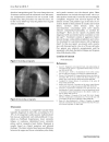 Báo cáo y học A severe coarctation of aorta in a 52 year old male a case report