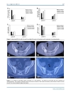 Báo cáo y học Treat Ankylosing Spondylitis with Methazolamide