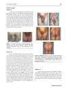 Báo cáo y học surgical Management of Hidradenitis Suppurativa