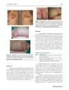 Báo cáo y học surgical Management of Hidradenitis Suppurativa