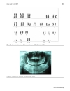 Báo cáo y học Non syndromic multiple supernumerary teeth in a family unit with a normal karyotype case report