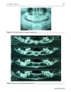 Báo cáo y học Non syndromic multiple supernumerary teeth in a family unit with a normal karyotype case report