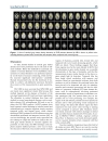 Báo cáo y học A Voxel based Morphometric Analysis of Cerebral Gray Matter in Subcortical Ischemic Vascular Dementia Patients and Normal Aged Controls