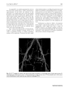 Báo cáo y học Changes of uterine blood flow after vaginal radical trachelectomy VRT in patients with early stage uterine invasive cervical cancer