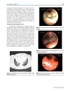 Báo cáo y học Bronchial Anthracofibrosis Case with Endobronchial Tuberculosis