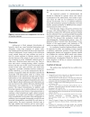 Báo cáo y học Bronchial Anthracofibrosis Case with Endobronchial Tuberculosis